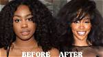 A Comprehensive Guide for Sza Before Surgery