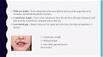 A Comprehensive Guide to Enhancing Lip Height: Say Goodbye to Shameless Lips