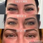 Botox Jelly Roll