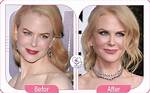 Cosmetic Enhancements: a Glimpse into Nicole Kidman's Plastic Surgery Journey