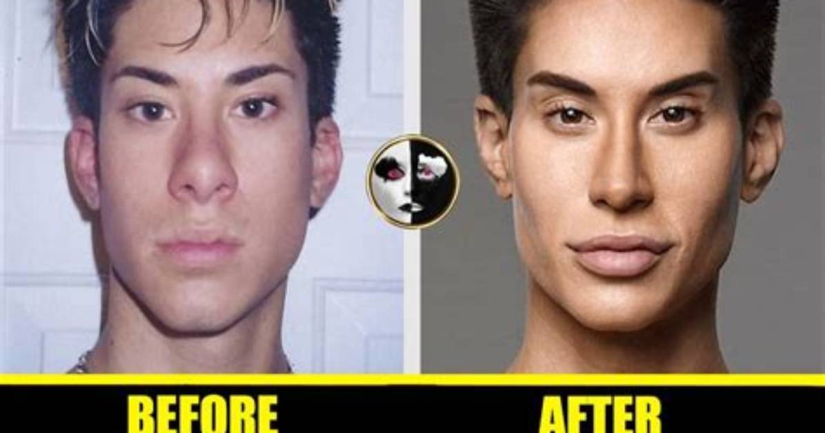 Did Mateo Blanco Have Plastic Surgery? Before and After Photos on Instagram -Details to Know |