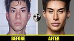 Did Mateo Blanco Have Plastic Surgery? Before and After Photos on Instagram -Details to Know |