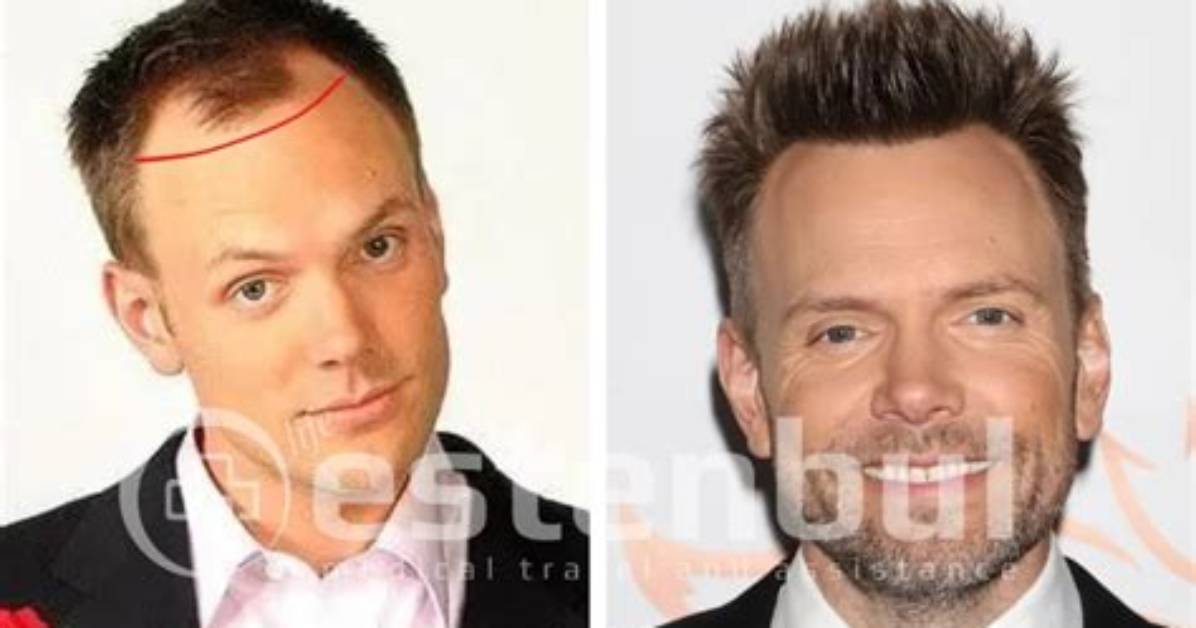 Does Joel Mchale Have Hair Plugs? His Hairline Is Telling