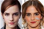 Emma Watson's Nose Surgery Journey
