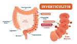How to Pronounce Diverticulitis