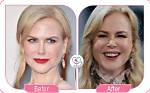 Nicole Kidman Facelift: a Comprehensive Look at Her Transformation
