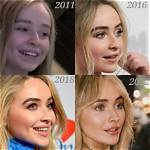 Sabrina Carpenter's Lip Fillers: Exploring the Transformation