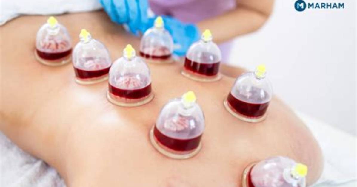 The Ultimate Bust-Boosting Cupping Therapy