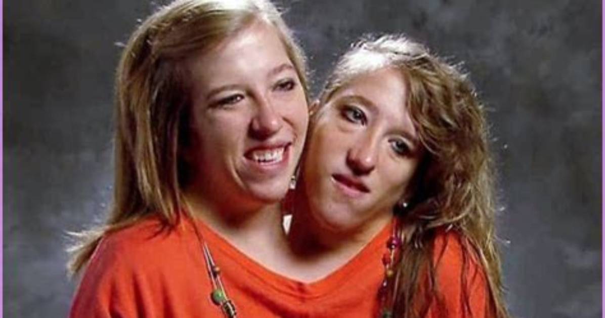 Tragic Loss: Conjoined Twins, Abby and Brittany, Succumb to Pregnancy Complications