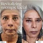 Transformations of the Face: Before and After High Cortisol Levels
