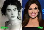 Understanding Kimberly Guilfoyle Before Surgery: a Journey of Transformation