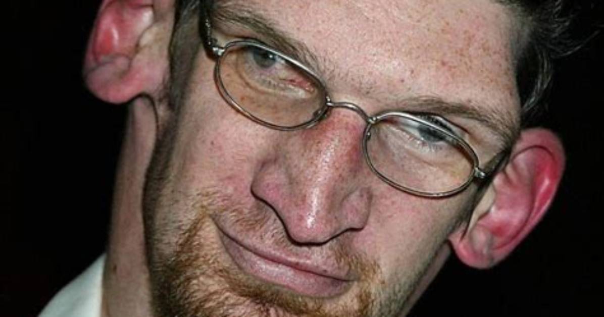 Understanding Matthew Mcgrory's Disease: a Deep Dive into Acromegaly