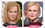 Unmasking Nicole Kidman's Surgery: Before and After Transformations