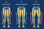 Unveiling the Secrets of Knock Knees Celebrities: Discoveries and Insights