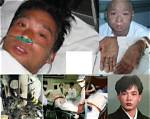What Happened to Hisashi Ouchi: a Tragic Tale of Nuclear Disaster